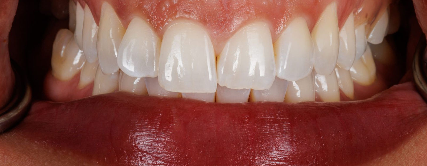 Before treatment, retracted view: the upper central incisors show mismatched length and an uneven biting edge on one tooth.