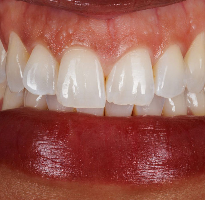 Before treatment, retracted view: the upper central incisors show mismatched length and an uneven biting edge on one tooth.