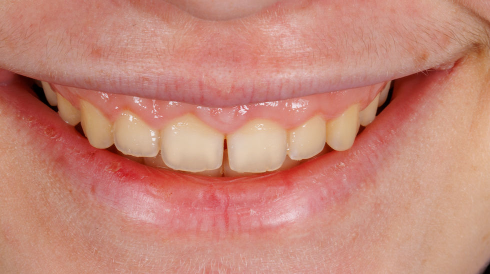 Emergency cosmetic dentistry composite veneer repair before and after – SOL Dental Arts Maspeth