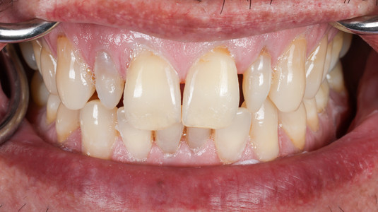 Ultra-thin composite veneers for small lateral teeth at SOL Dental Arts, Maspeth Queens — case photo 7