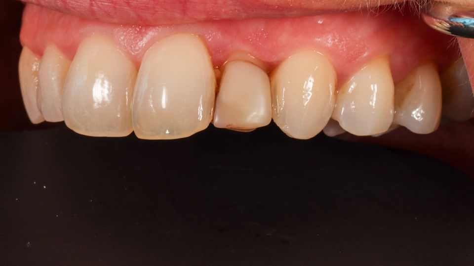 Failing bonding replaced with composite veneer before and after — cosmetic dentistry case at SOL Dental Arts in Maspeth, Queens