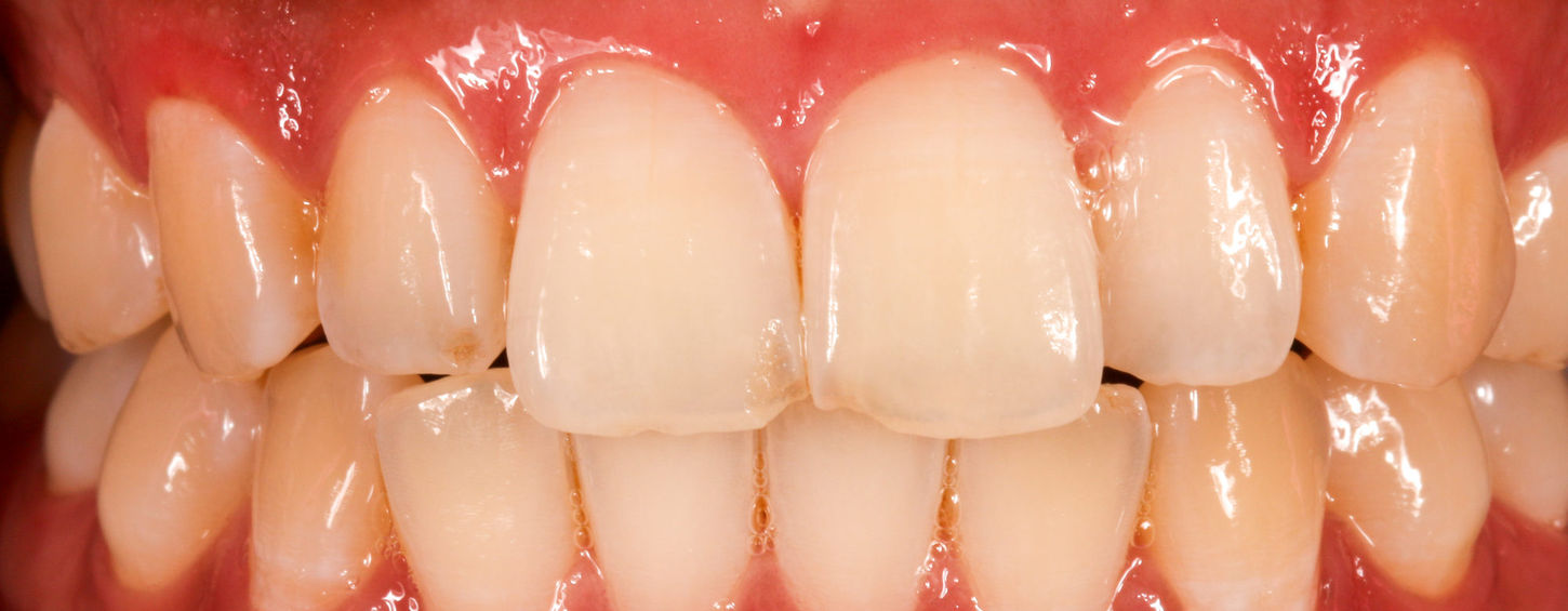 Before detail of chipped front teeth before aesthetic bonding