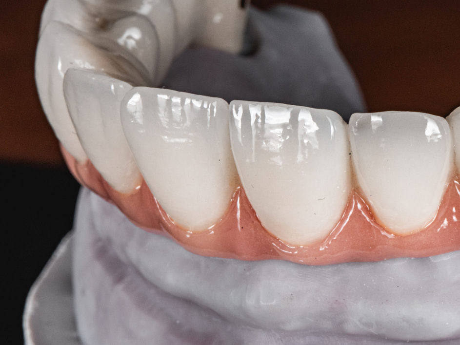 Full mouth rehabilitation before and after at SOL Dental Arts in Queens