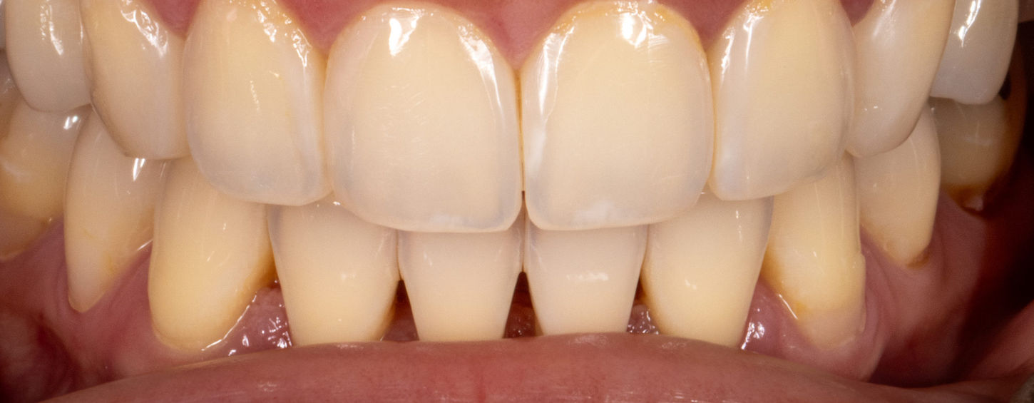 Completed smile transformation after Bioclear black triangle closure in Maspeth Queens