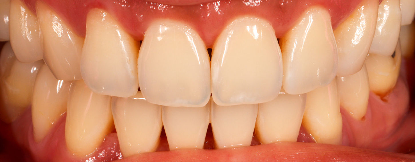 Close-up of black triangle spaces before conservative Bioclear bonding treatment