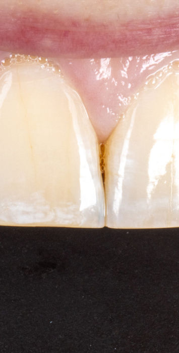 Before-and-after style image from failing bonding repair and replacement case