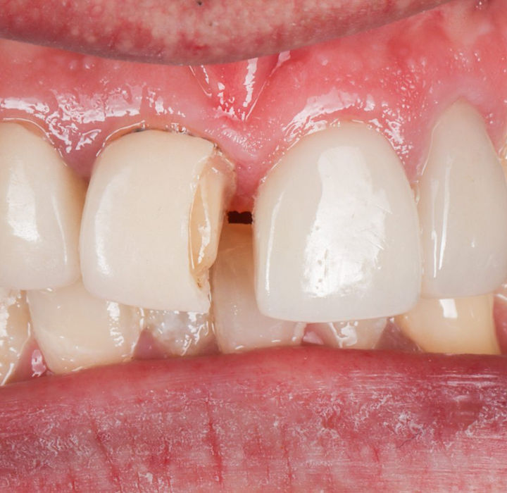 Before treatment, retracted view: a fractured crown on an upper central incisor with part of the facing broken away and a dark, uneven margin near the gum.