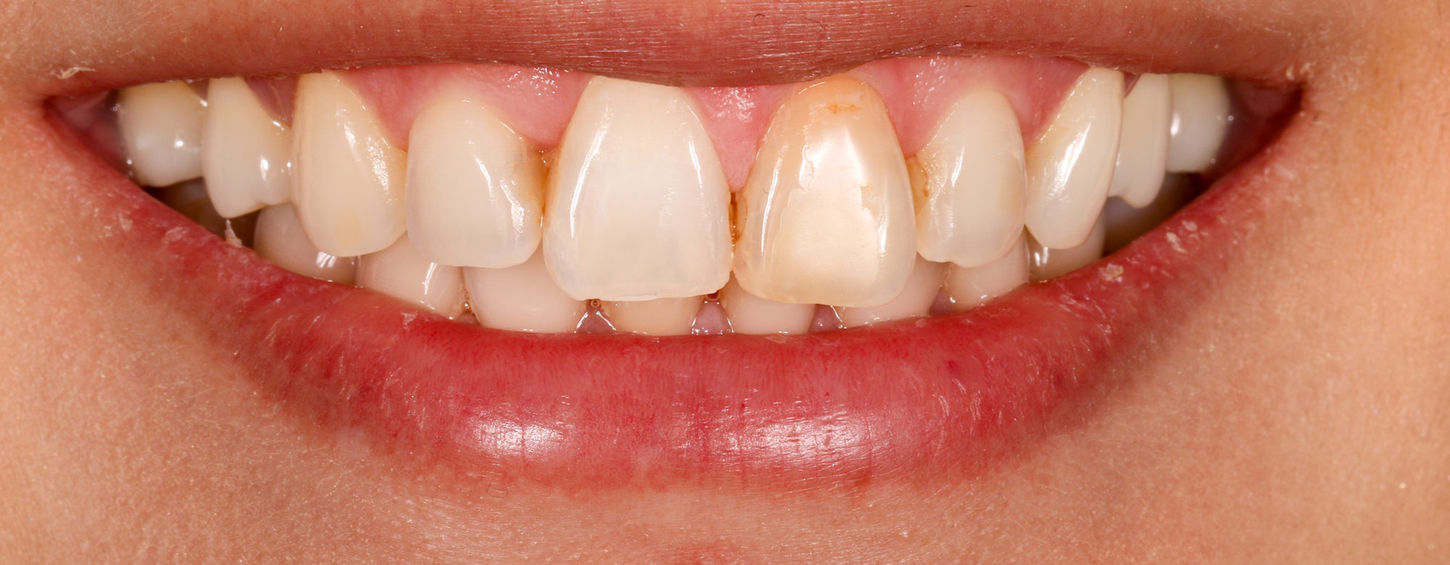 Single discolored tooth veneer after photo with natural front-tooth integration