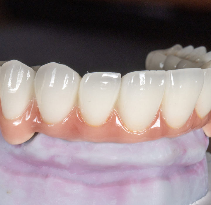 Maspeth Queens All-on-X implant rehabilitation case with fixed full arch teeth