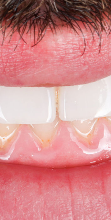 Conservative peg lateral enhancement before and after – Maspeth NY