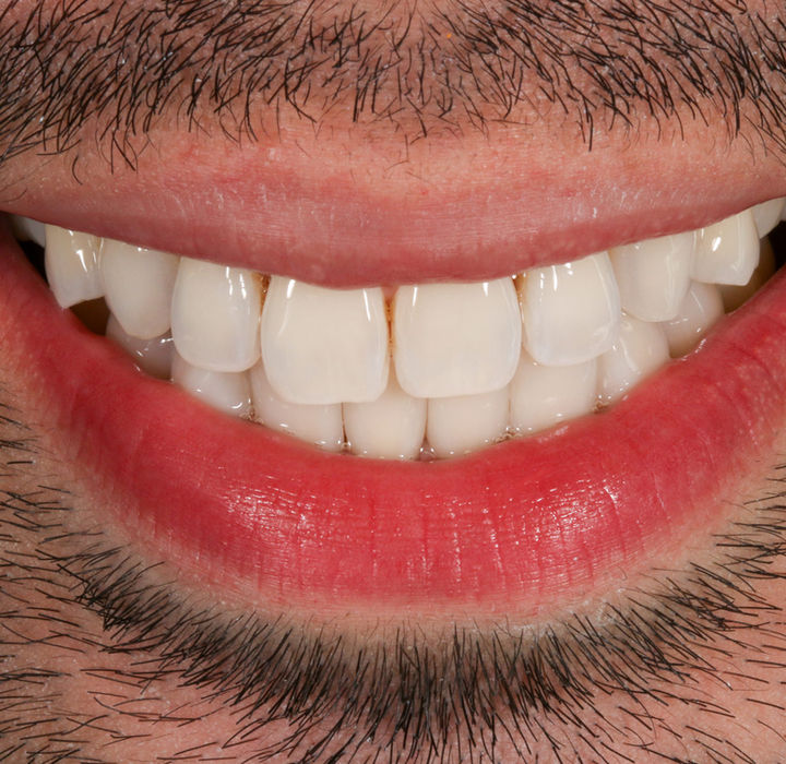 Bioclear non-invasive composite bonding result for front-tooth space closure