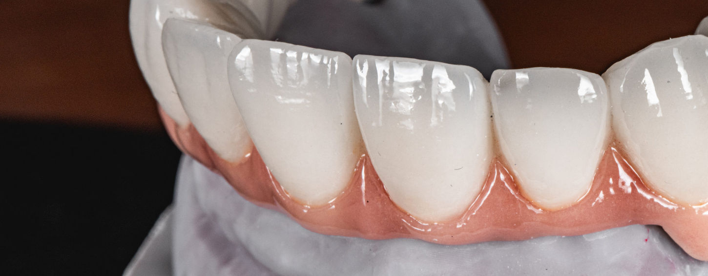 Implant-supported full mouth rehabilitation showing improved smile stability