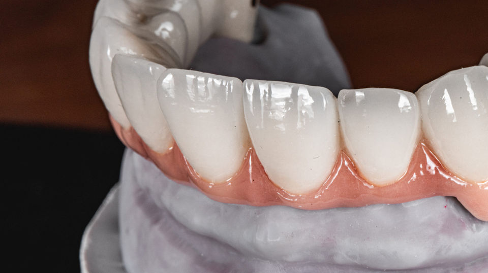 Implant-supported full mouth rehabilitation showing improved smile stability