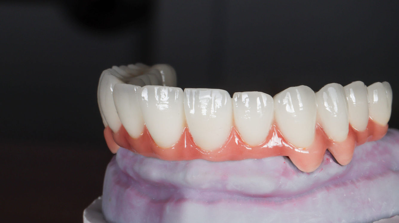 Full arch implant prosthesis case image from SOL Dental Arts in Queens