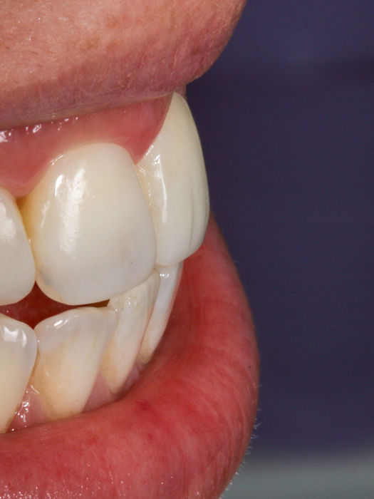 Cosmetic composite bonding on central and lateral incisors for improved smile symmetry — before and after in Maspeth, Queens