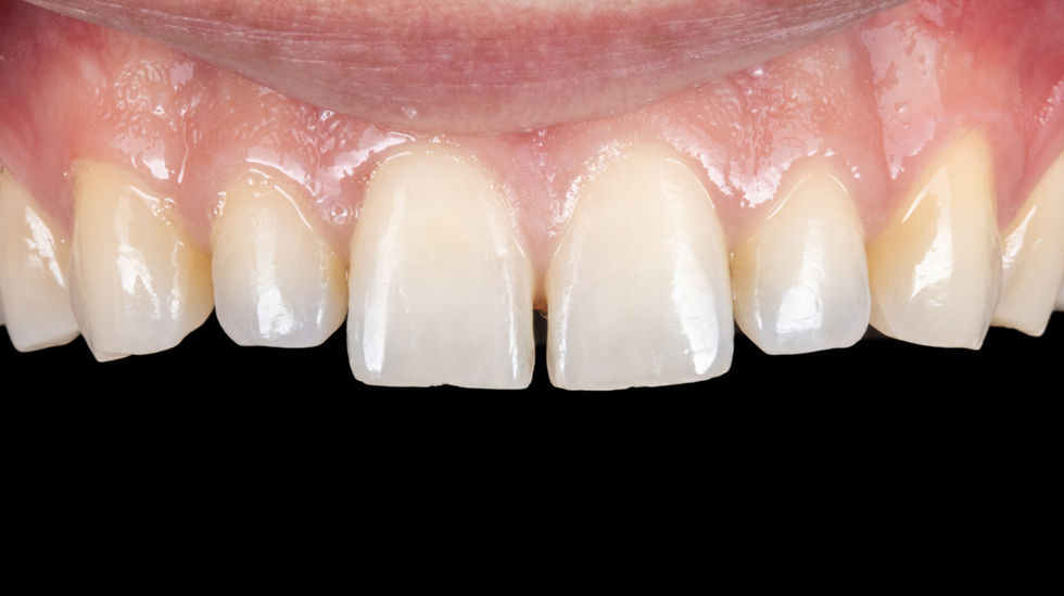 Non-invasive bonding space closure Bioclear before and after – SOL Dental Arts Maspeth