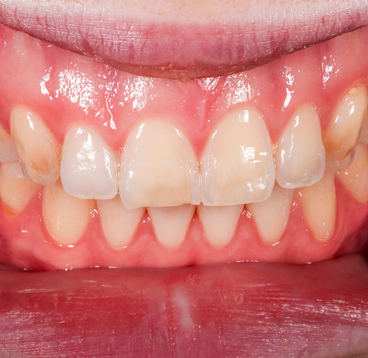 Completed discolored front teeth bonding veneer result with balanced smile color