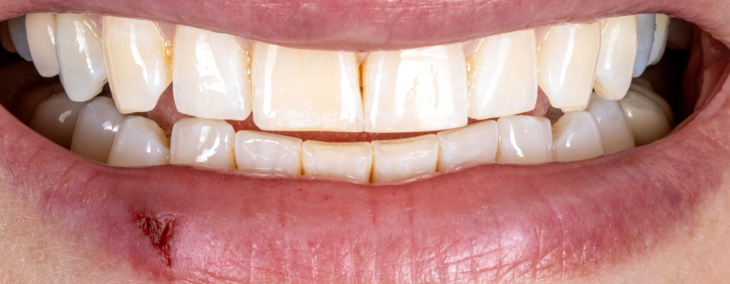 Composite resin bonding repair case at SOL Dental Arts Maspeth NY