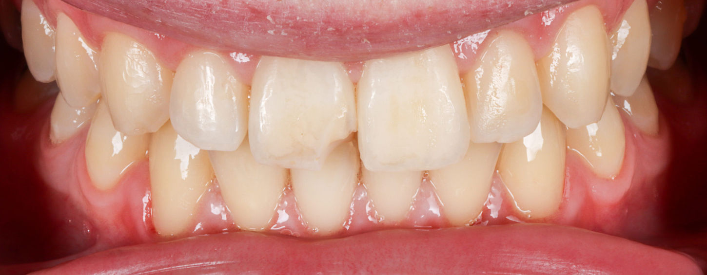Single chipped tooth bonding result with smooth polish and contour