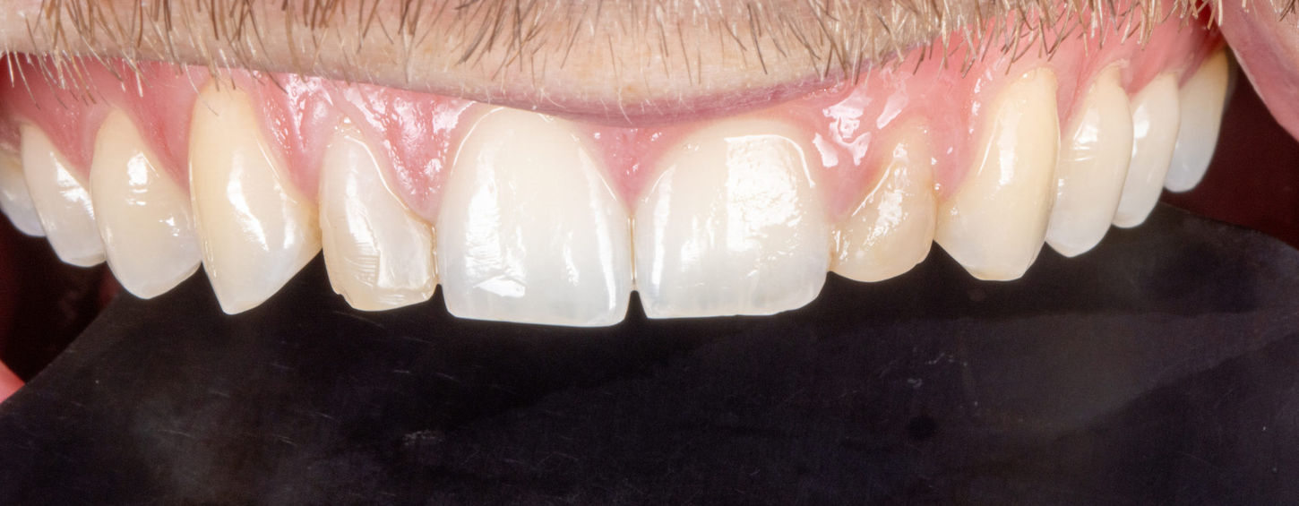 Natural-looking composite veneer case photo by SOL Dental Arts