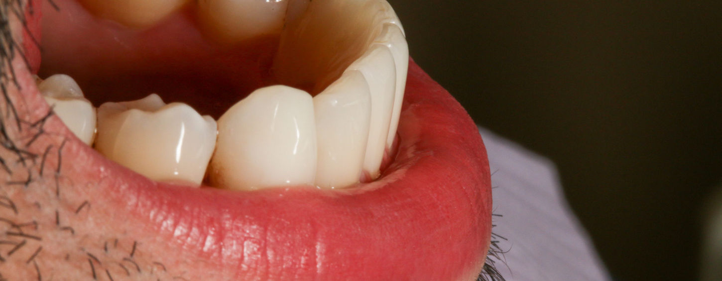 Front-tooth space closure case photo with Bioclear-style composite bonding