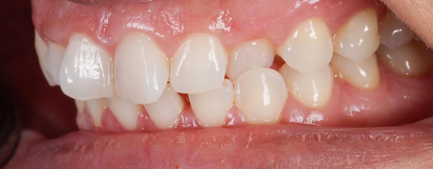 Before treatment, side view: the upper left canine sits tucked behind the arch, biting inside the lower teeth (a crossbite).