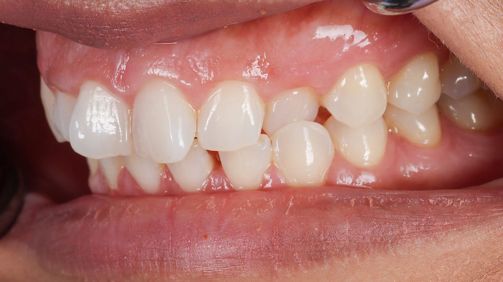 Reshaping a Canine in Crossbite with Composite Bonding