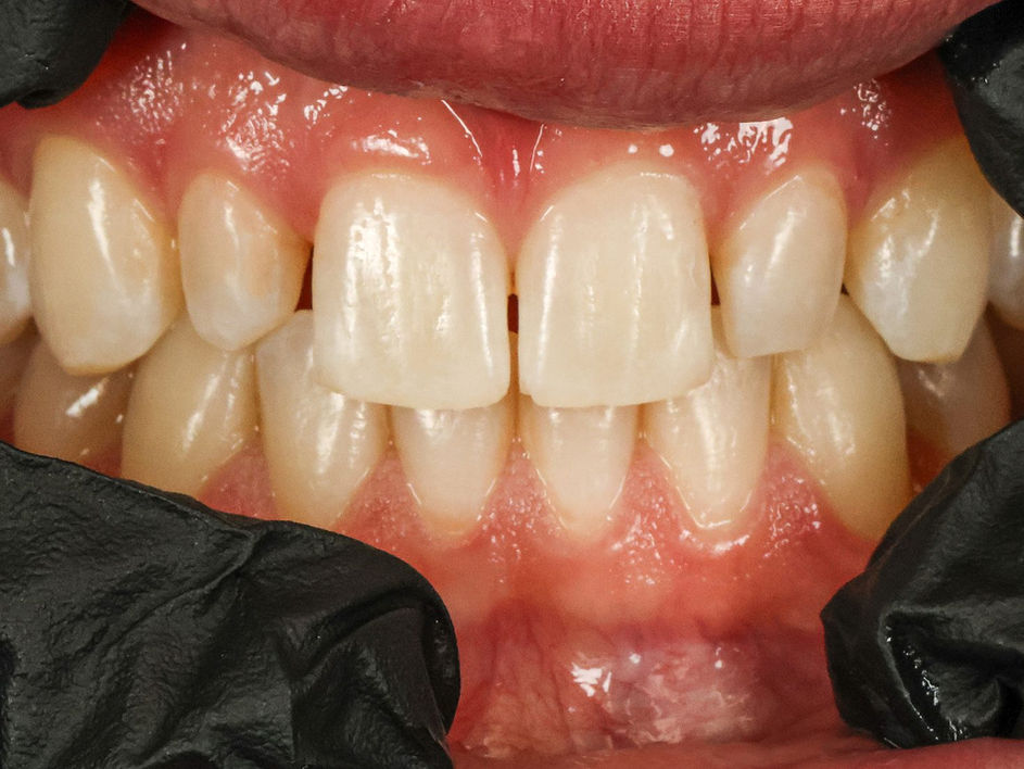 Peg lateral incisors rebuilt with no-prep 3D-printed crowns — before and after at SOL Dental Arts, Maspeth, Queens