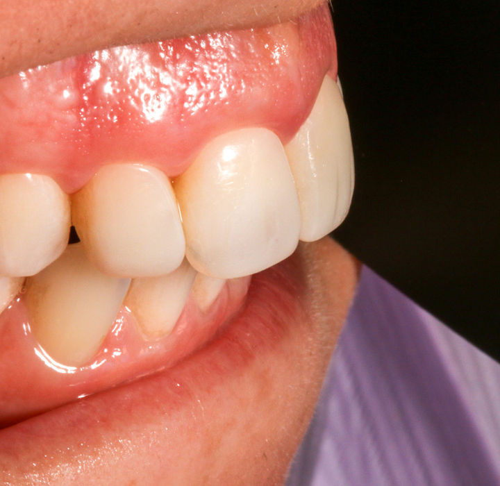Additional close-up of bonded central and lateral incisors with refined edges.