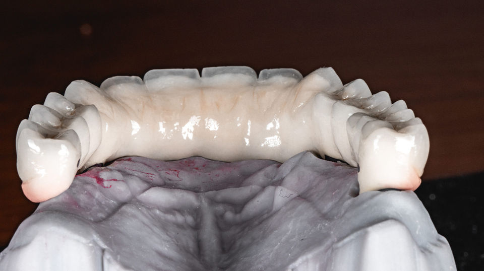 All-on-X implant teeth designed for natural-looking full arch smile esthetics
