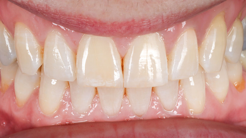 Chipped tooth bonding repair before and after – Maspeth Queens dentist