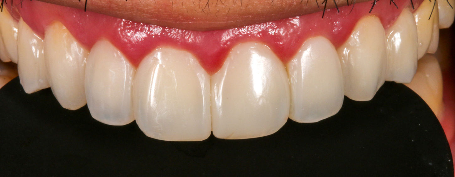 Follow-up view of Bioclear space closure with natural front-tooth proportions