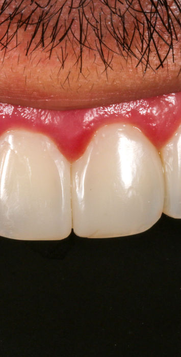 Follow-up view of Bioclear space closure with natural front-tooth proportions