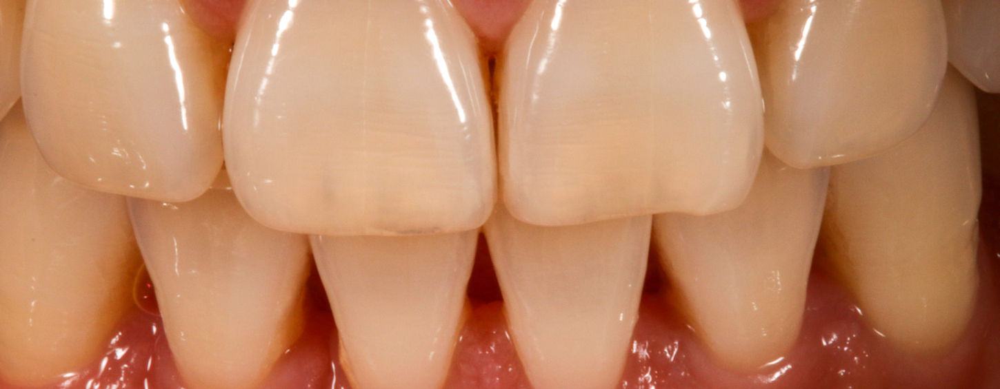 Bioclear black triangle closure before view at SOL Dental Arts in Maspeth Queens