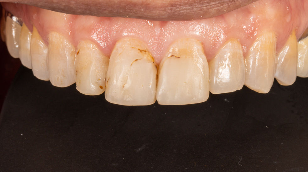 Natural-looking veneers front teeth before and after – Maspeth Queens dentist