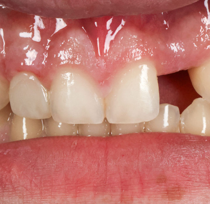 Final smile view of same-day peg lateral bonding and flipper treatment in Maspeth, Queens.