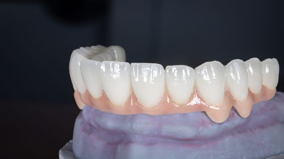Full arch replacement teeth supported by dental implants in Maspeth Queens