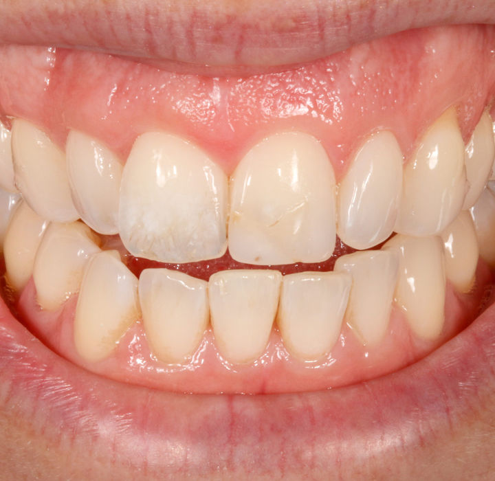 Pre-treatment view of central and lateral incisors before cosmetic bonding at SOL Dental Arts in Maspeth, Queens.