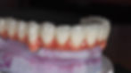 All-on-X Full-Arch Dental Implants in Maspeth, Queens