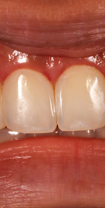 Completed Bioclear black triangle treatment with natural front tooth proportions