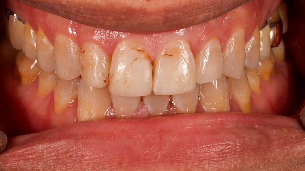 Full smile rehabilitation before and after – Maspeth Queens dentist