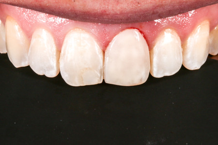 Dark central incisor treated with composite bonding at SOL Dental Arts, Maspeth Queens — case photo 4