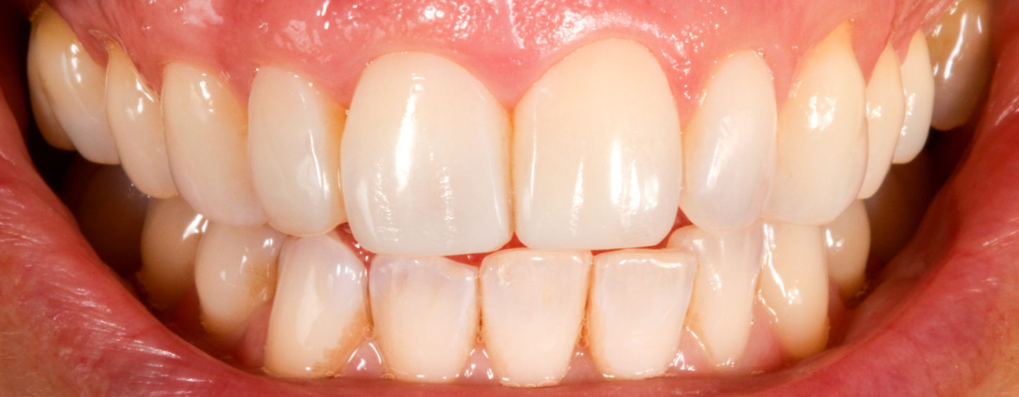 Detailed view of central and lateral incisor bonding after finishing and polish.
