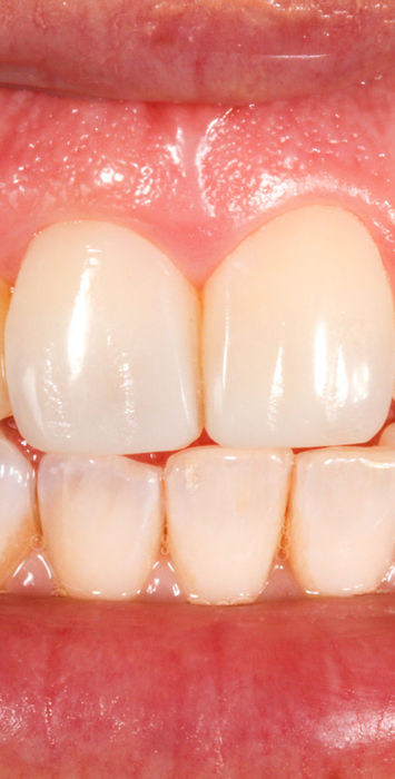 Detailed view of central and lateral incisor bonding after finishing and polish.
