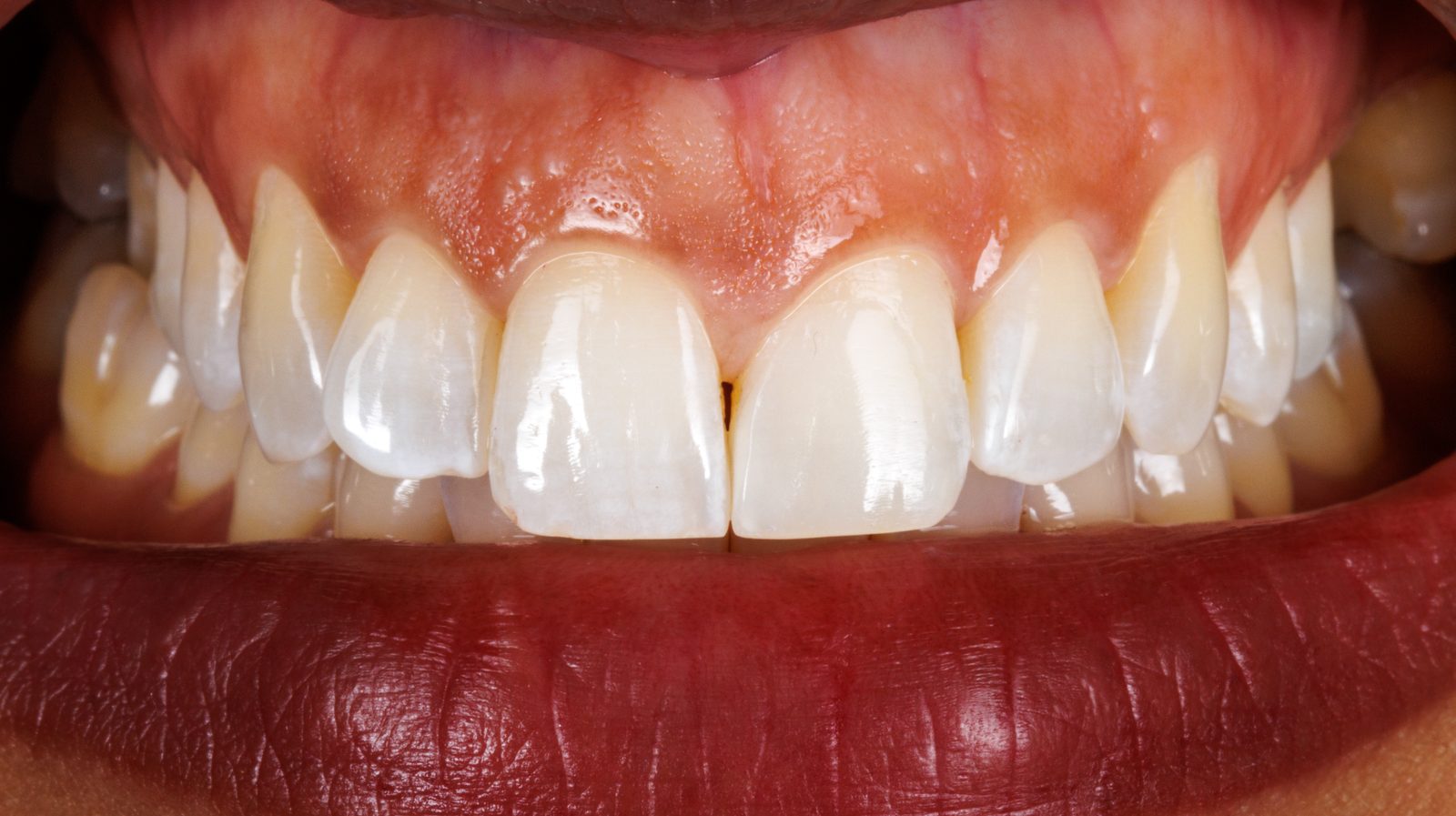 Evening Out Two Front Teeth With Minimally Invasive Bonding