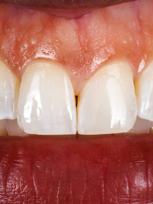Two upper front teeth evened out with minimally invasive composite bonding — before and after at SOL Dental Arts, Maspeth, Queens.