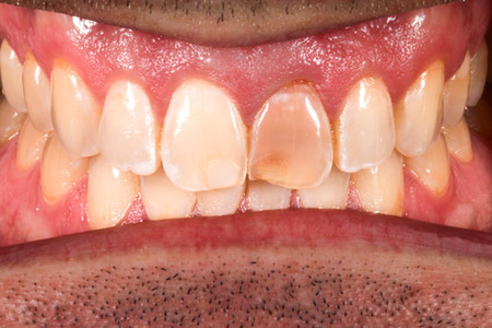 Dark central incisor treated with composite bonding at SOL Dental Arts, Maspeth Queens — case photo 6
