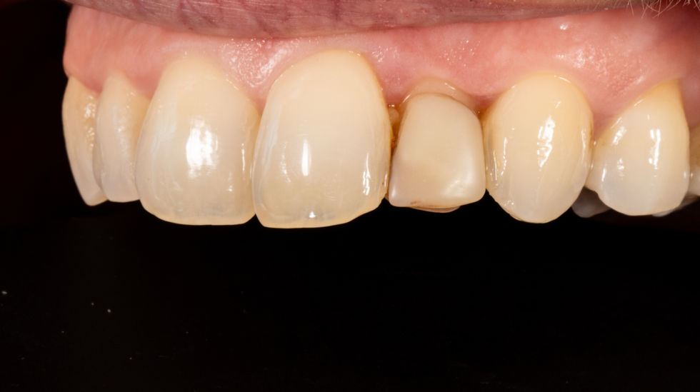 Failing bonding repair and replacement results in Maspeth, Queens