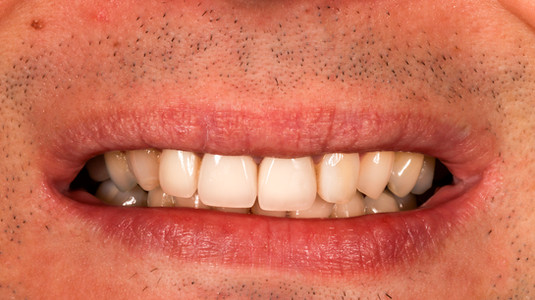 Failing composite bonding repaired and replaced at SOL Dental Arts, Maspeth Queens — case photo 6