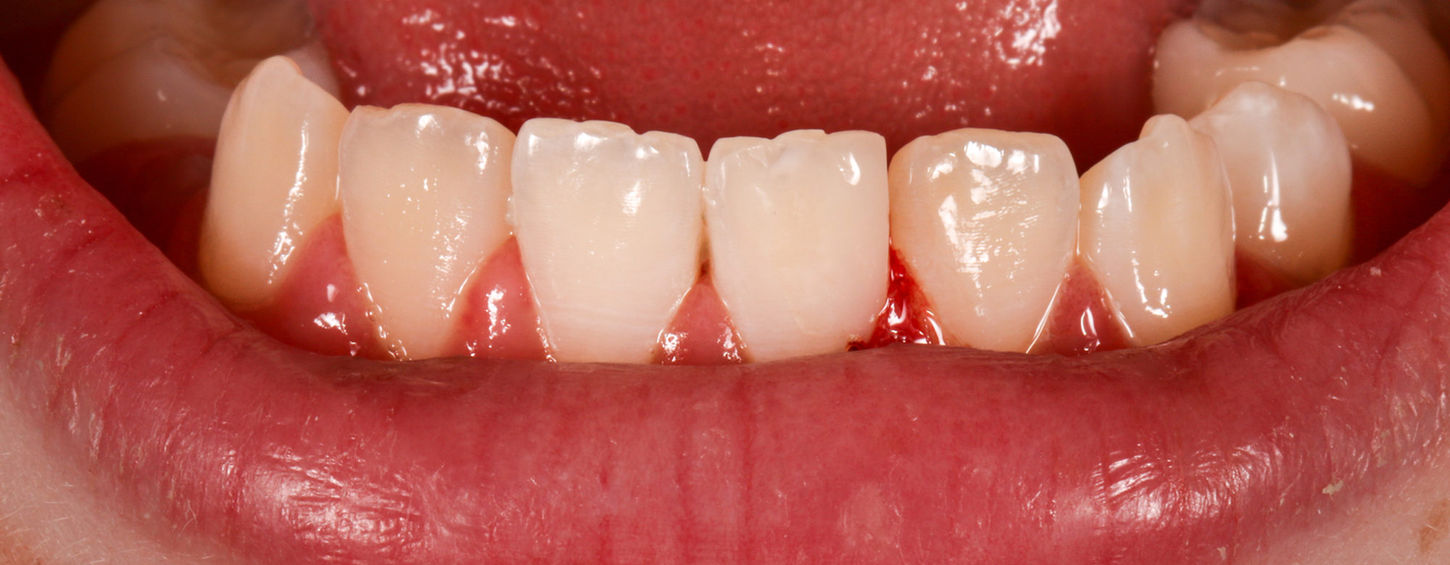 After view of a chipped lower incisor restored with conservative composite bonding.
